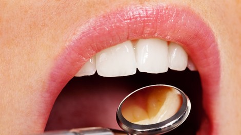 Zobni vsadki in implantanti - rešitev za brezzobost!