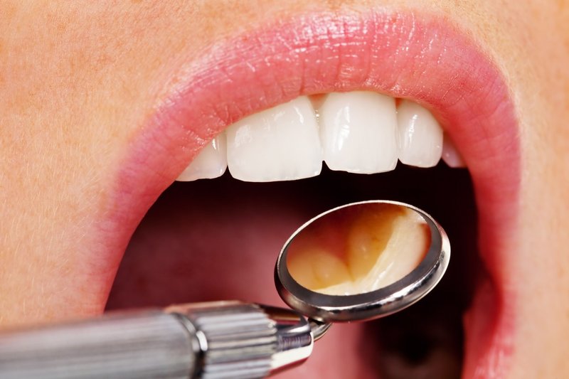 Zobni vsadki in implantanti - rešitev za brezzobost! (foto: profimedia)