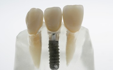Zobni vsadki in implantanti - rešitev za brezzobost!