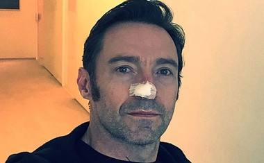 Hugh Jackman prestal novo zdravljenje kožnega raka