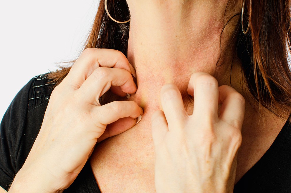 Na kaj vse smo lahko alergični? (foto: Shutterstock)