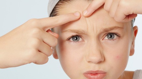 Akne niso zgolj kozmetična bolezen - in najstniki to dobro vedo!