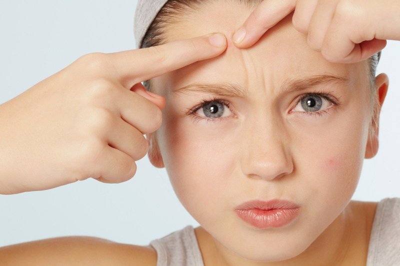 Akne niso zgolj kozmetična bolezen - in najstniki to dobro vedo! (foto: profimedia)