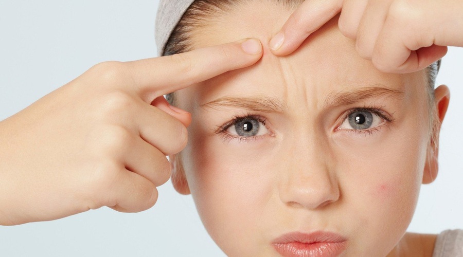 Akne niso zgolj kozmetična bolezen - in najstniki to dobro vedo! (foto: profimedia)