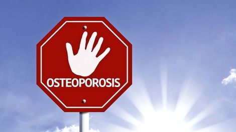 Osteoporoza: Poskrbite za svoje kosti!