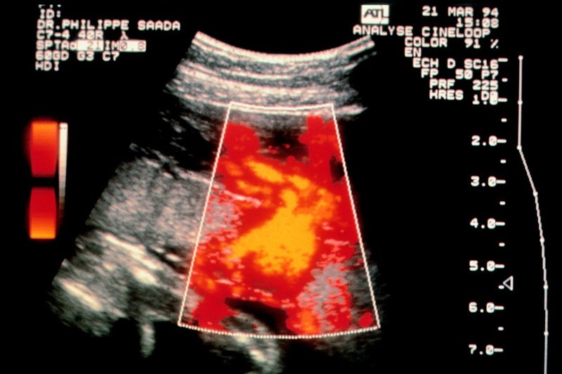 Umetna posteljica, ki so jo razvili britanski znanstveniki, bo izboljšala razumevanje nosečniški težav (foto: profimedia)