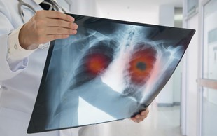 Pljučni rak - zahrbtna bolezen, ki pri ženskah še vedno narašča!