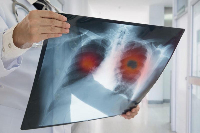 Pljučni rak - zahrbtna bolezen, ki pri ženskah še vedno narašča! (foto: SHUTTERSTOCK)