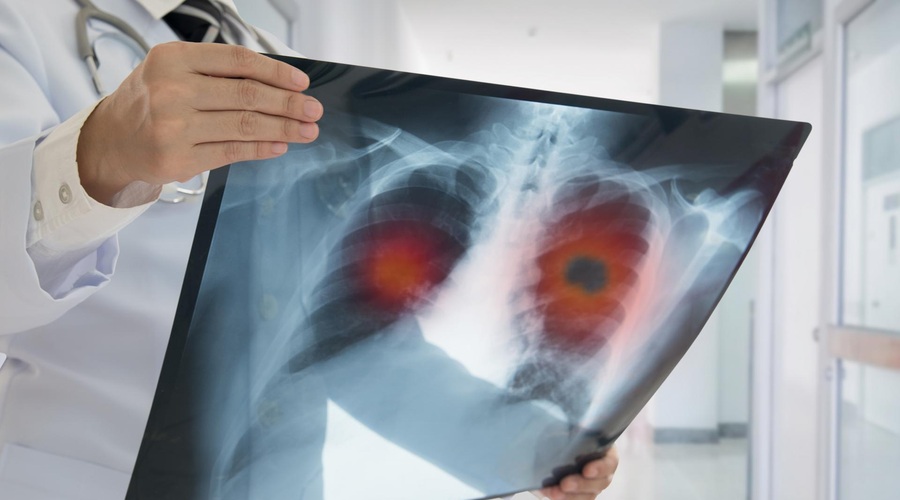 Pljučni rak - zahrbtna bolezen, ki pri ženskah še vedno narašča! (foto: SHUTTERSTOCK)