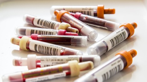 V Nemčiji razvili potencialen krvni test za raka dojk
