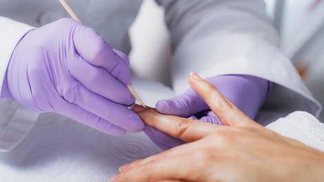 Američanka zaradi manikure skoraj ostala brez roke: okužila se je z nevarno bakterijo