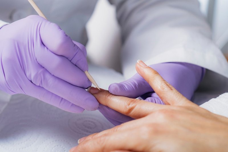 Američanka zaradi manikure skoraj ostala brez roke: okužila se je z nevarno bakterijo (foto: Profimedia)