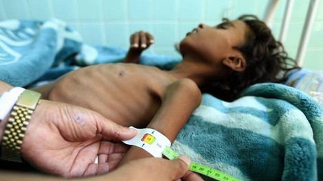 Rekordna podhranjenost v Jemnu - ogroženo preživetje milijonov otrok