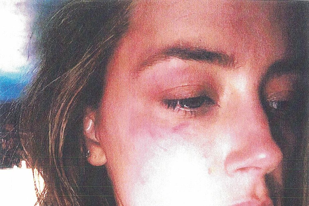 Fotografija, s katero je Amber Heard na sodišču v Los Angelesu dokazovala fizični napad, Johnny Depp pa je potem dobil sodno prepoved približevanja. Ločitev je sledila 2 dni kasneje.