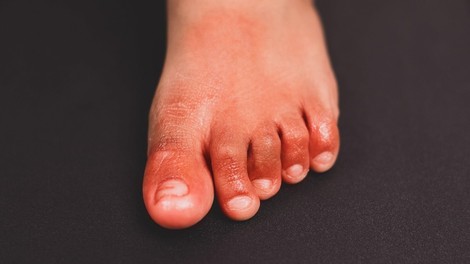 Omikronovi simptomi tudi s spremembami na koži: od rdečkastih izpuščajev do covidnih prstov!