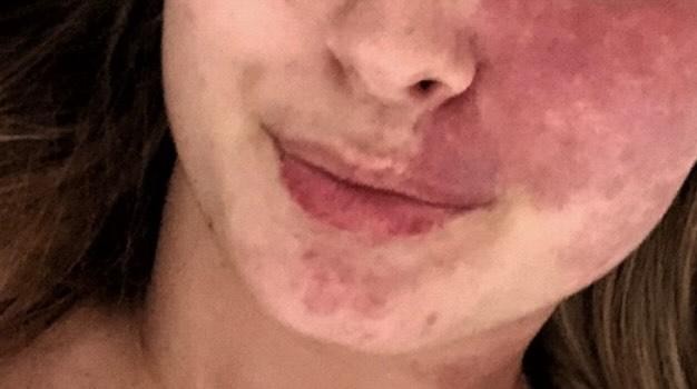 Tina je kolegicam v uredništvu Cosmopolitan. si poslala fotografijo svojih ustnic pred posegom in zaupala: "S posegom sem res zelo …