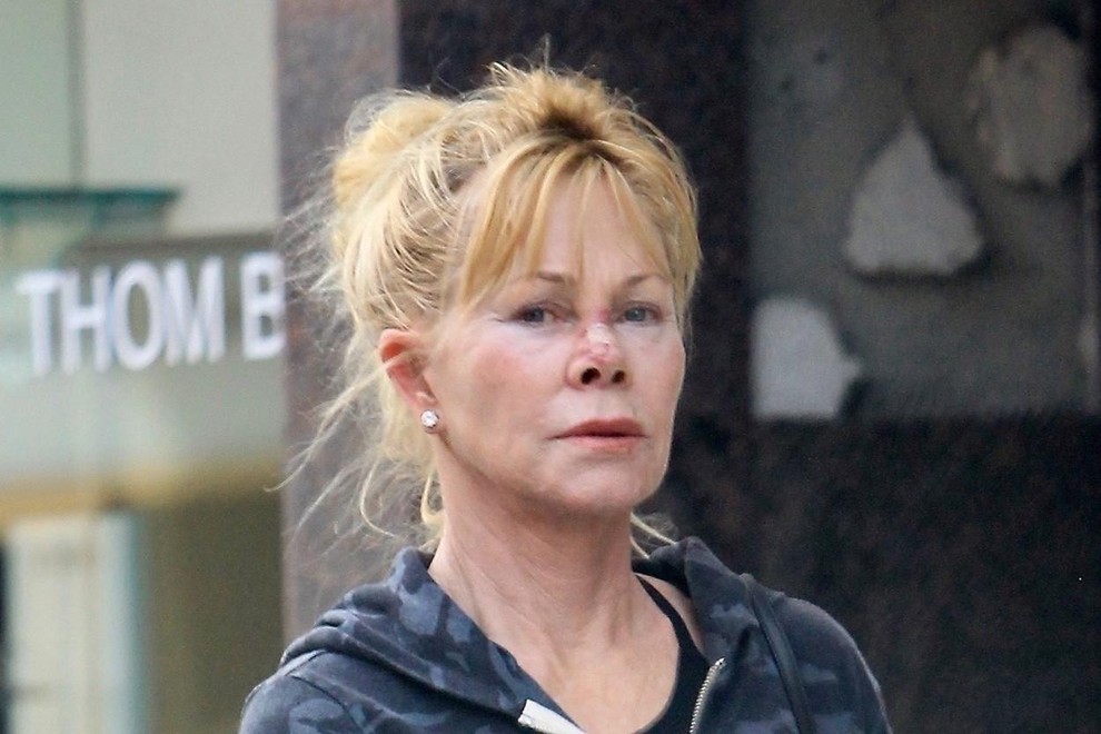 Melanie Griffith, nekoč ena izmed najlepših hollywoodskih igralk, je bila iskrena glede svojih izkušenj z lepotnimi operacijami. Povedala je, kako …