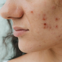 Mesto, kjer imate akne na obrazu pove, kakšne hormonske težave imate