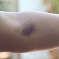 Če se vam modrice pojavijo že po najmanjšem udarcu, je krivec zelo verjetno premalo tega vitamina