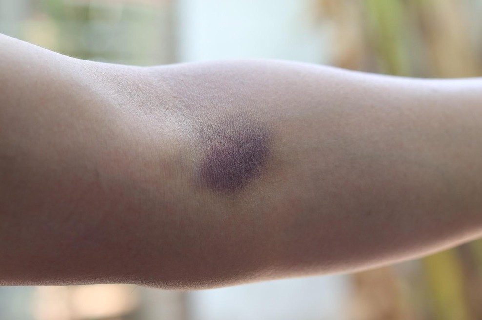 Če se vam modrice pojavijo že po najmanjšem udarcu, je krivec zelo verjetno premalo tega vitamina (foto: Profimedia)