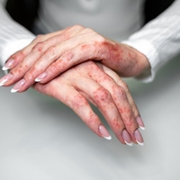 Naravne rešitve za nadležni ekcem, ki pozimi dela težave mnogim