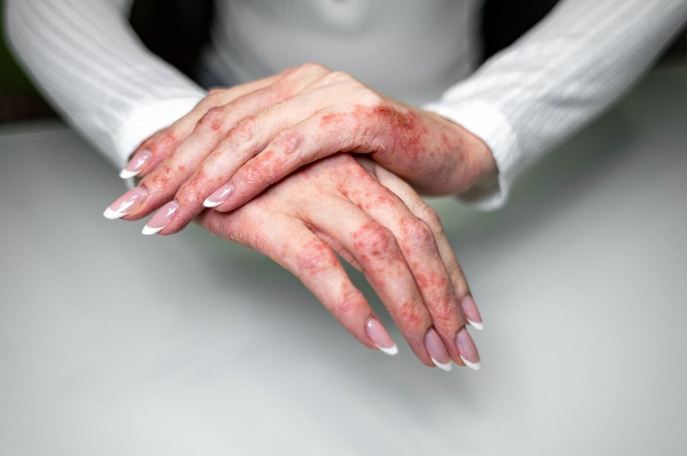 Naravne rešitve za nadležni ekcem, ki pozimi dela težave mnogim (foto: Profimedia)