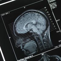 Spolni sadisti kažejo izrazite anatomske posebnosti možganov