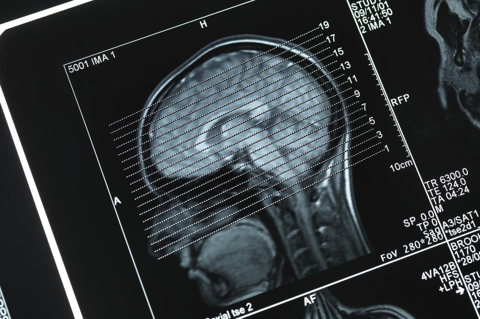 Spolni sadisti kažejo izrazite anatomske posebnosti možganov (foto: profimedia)