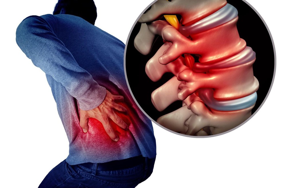 Bolečine v hrbtu: Fizioterapevti razkrivajo 7 vaj, ki prinesejo takojšnje olajšanje (foto: profimedia)